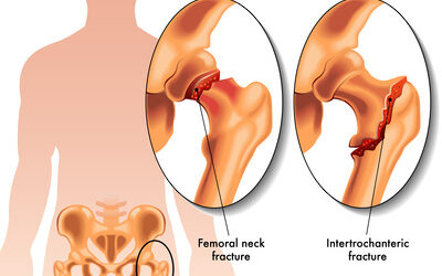 Never Ignore Hip and Thigh Pain (Here’s Why)